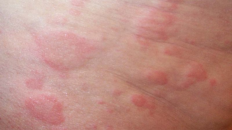 Allergies Can Be a Concern